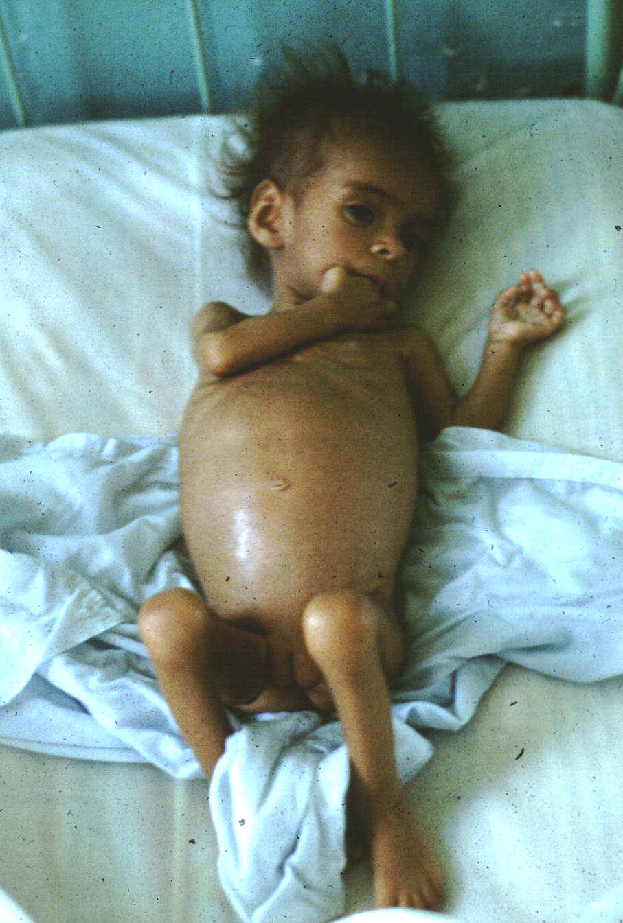 African Child Belly